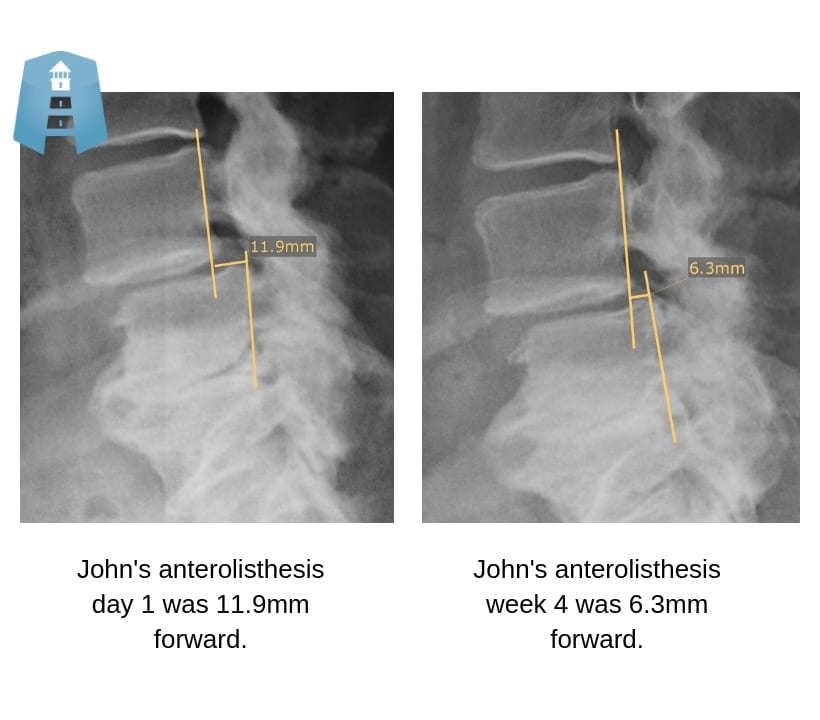 Example of a degenerated, arthritic spine that correction is possible with today's corrective chiropractic care, chiropractic biophysics certified, denneroll table, kelowna chiropractor