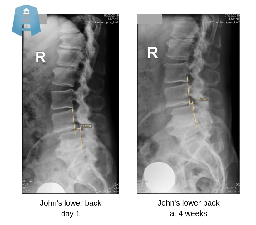 Corrected x-rays of an advanced arthritic lower spine with low back pain and sciatica