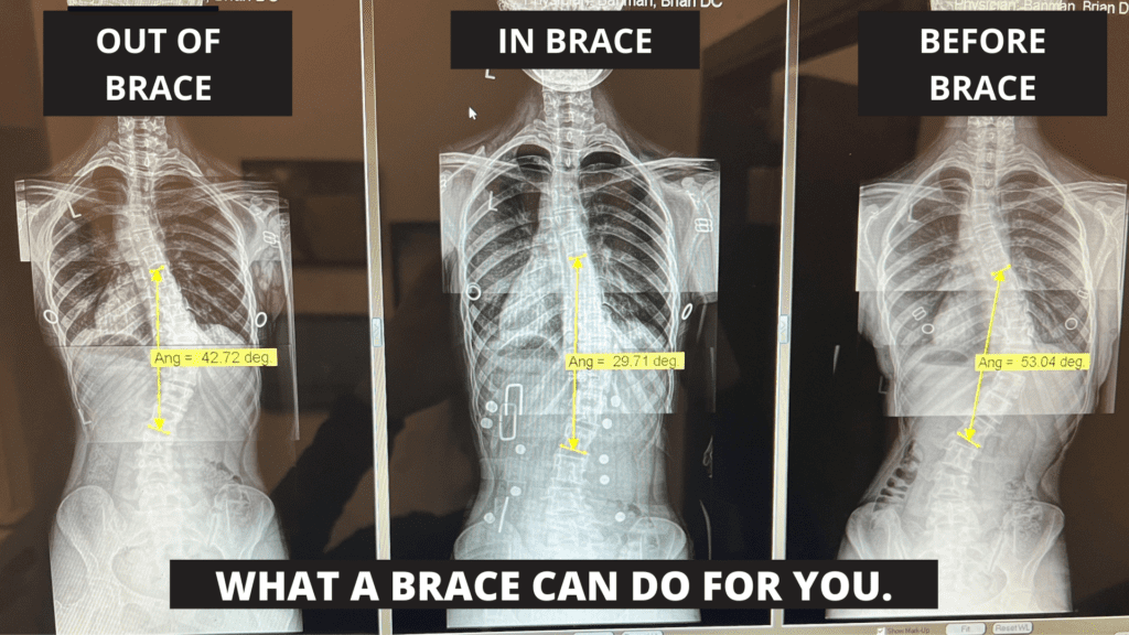 Before, during and after xrays of scoliosis treated with scolibrace