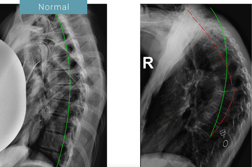 Hyperkyphosis Comparison