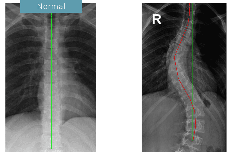 Scoliosis Comparison Lighthouse Chiropractic & Integrative Health